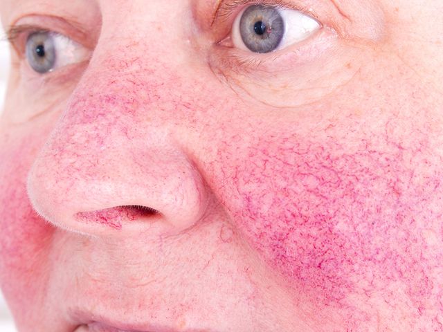 Rosacea