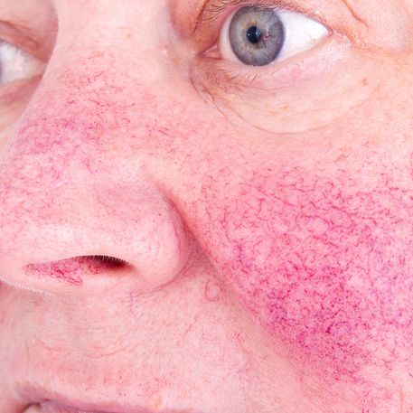 Rosacea